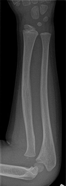 Lateral forearm radiograph of a child with open growth plates showing plastic bowing of the ulna and the radial head displaced off the capitellum.