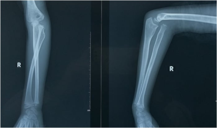 AP and lateral forearm radiographs showing anterior radial-head dislocation with plastic deformation of the ulna.