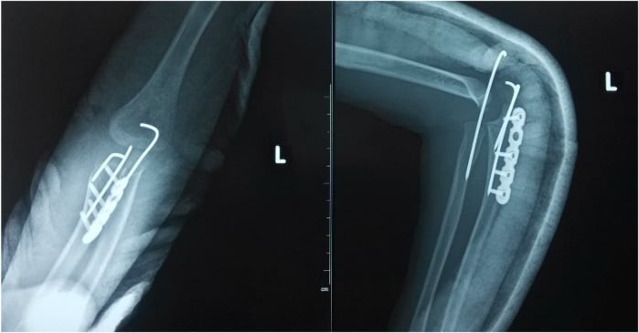 Postoperative radiographs showing proximal ulnar osteotomy plate fixation and a trans-articular K-wire.