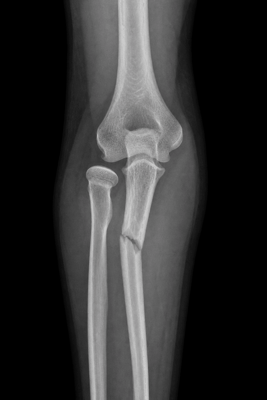 Radiograph of a Monteggia fracture-dislocation showing a proximal ulna fracture with the radial head dislocated out of line with the capitellum.