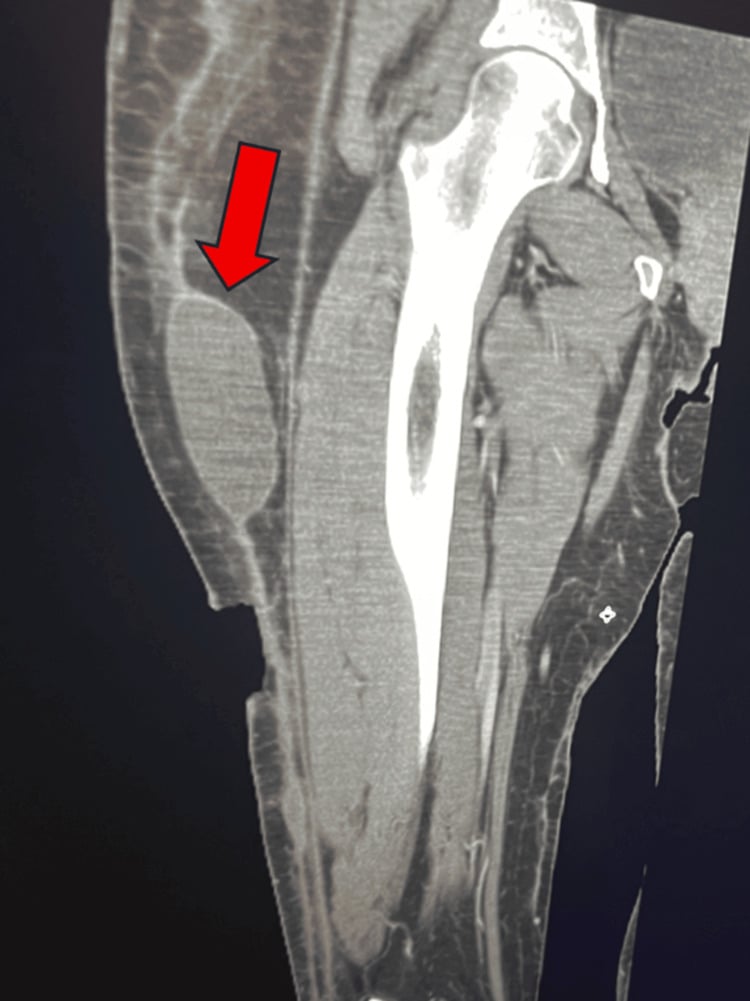 Sagittal CT of the thigh showing an extensive deep-subcutaneous Morel-Lavallee collection