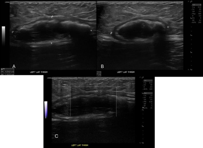 Long-axis, short-axis and Doppler ultrasound of a calcified chronic lesion