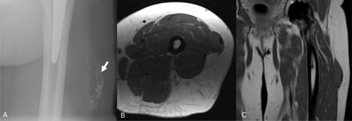 Radiograph and MRI of a chronic partially calcified Morel-Lavallee lesion
