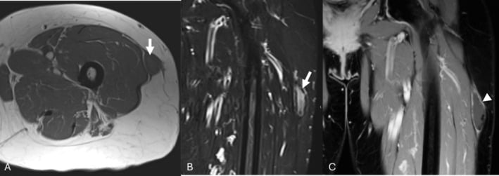 Axial T1, coronal STIR and post-contrast MRI of a chronic Morel-Lavallee lesion