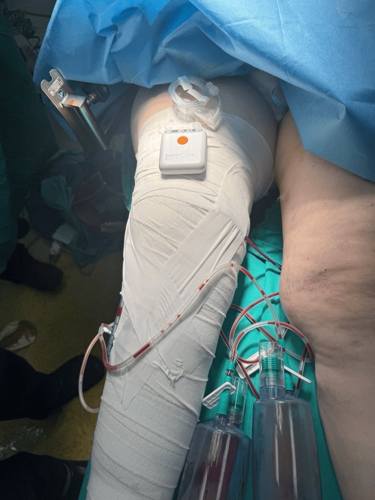 Postoperative compression dressing, drains and incisional negative-pressure therapy after debridement