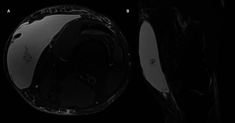 Axial and coronal MRI showing a distal-thigh Morel-Lavallee fluid collection