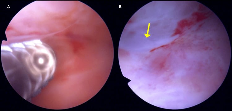 Endoscopic views of fluid and white fibrous pseudocapsule in a chronic Morel-Lavallee lesion