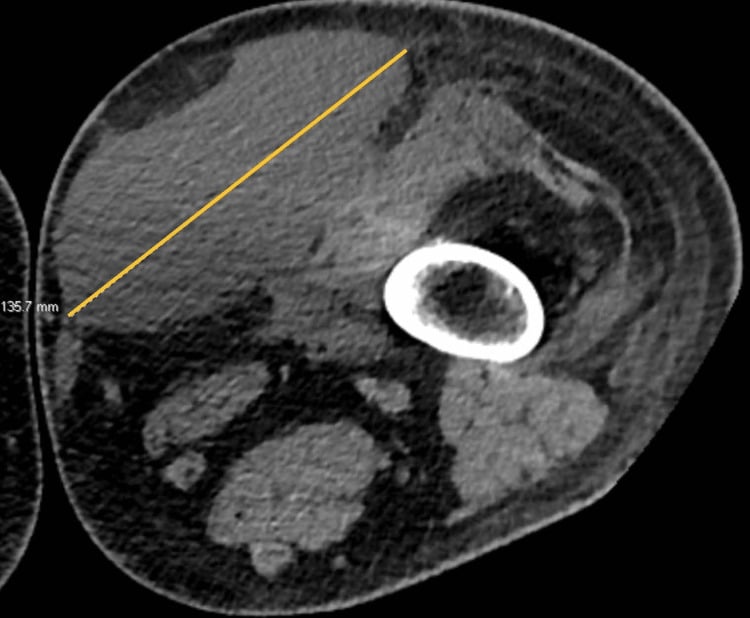 Axial CT showing a very large anteromedial thigh Morel-Lavallee collection