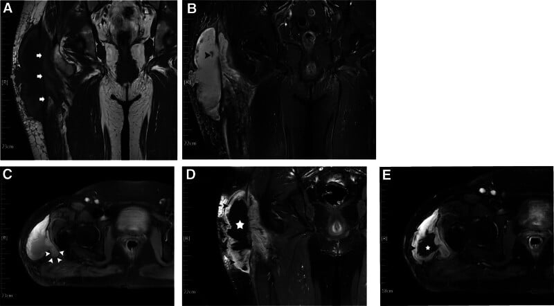 Multisequence MRI showing a large Morel-Lavallee lesion between fat and deep fascia at the hip
