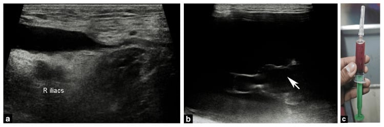 Hip ultrasound showing a septated subcutaneous collection with ultrasound-guided aspiration