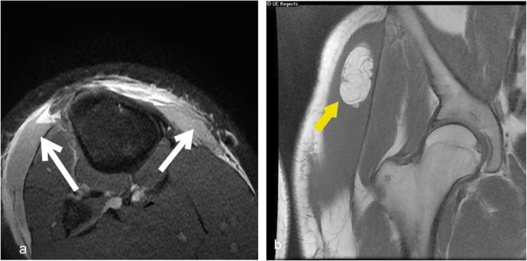 MRI examples of Morel-Lavallee lesions at the knee and hip