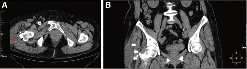 Axial and coronal CT showing a subcutaneous collection and separation plane over the hip