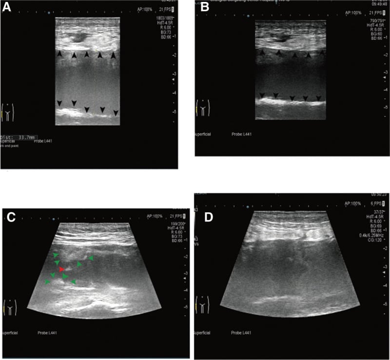 Multiplanar ultrasound of a Morel-Lavallee lesion over the proximal femur