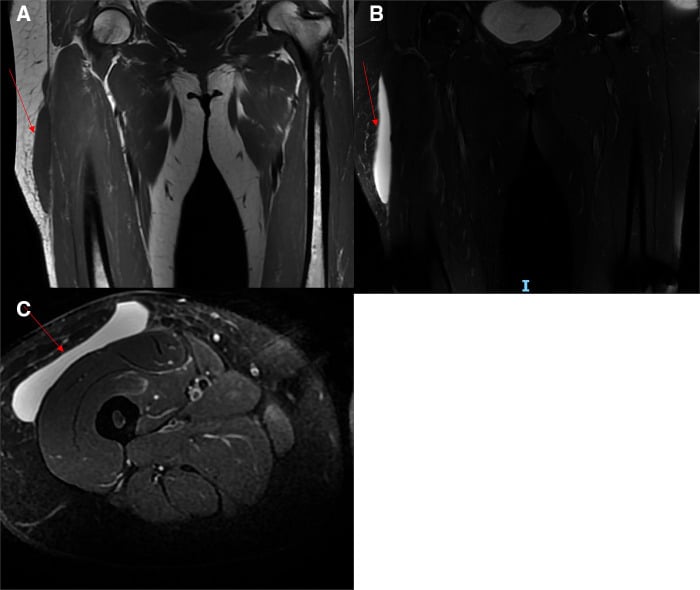 T1- and T2-weighted MRI showing a Morel-Lavallee lesion along the fascia lata