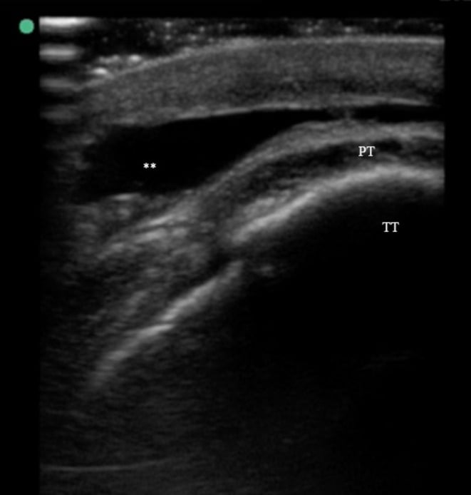 Short-axis point-of-care ultrasound over the tibial tuberosity showing a Morel-Lavallee fluid collection