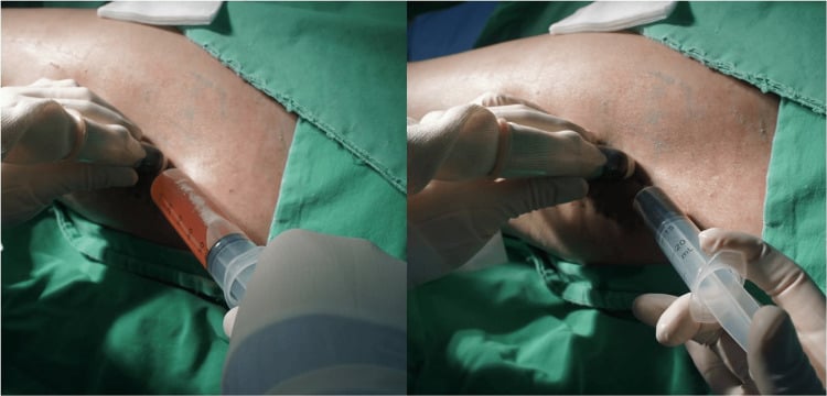 Ultrasound-guided aspiration followed by sclerosant injection into a recurrent Morel-Lavallee cavity