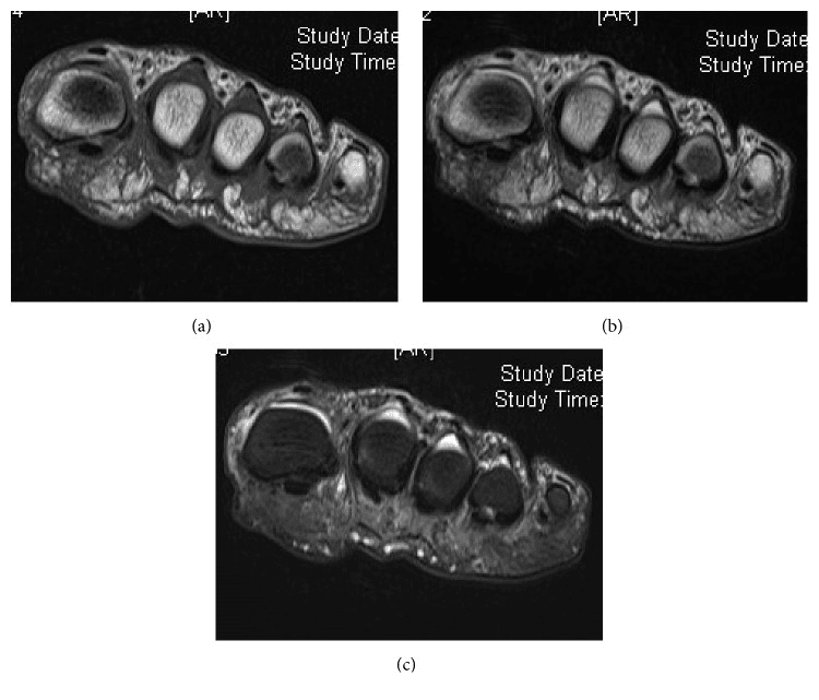 Three cross-sectional MRI panels of the forefoot from a reported case of an atypically dorsal second-web-space interdigital neuroma