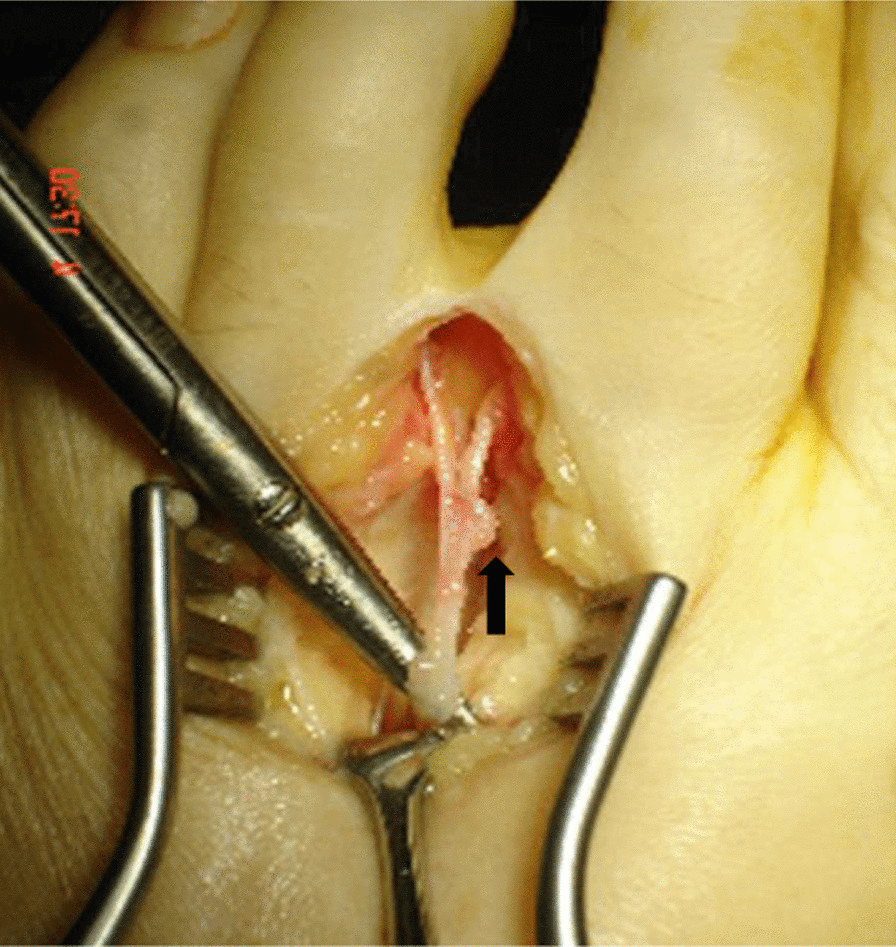 Intraoperative photograph of the common digital nerve held in forceps through a web-space incision, an arrow marking one of its branches, before dorsal transposition