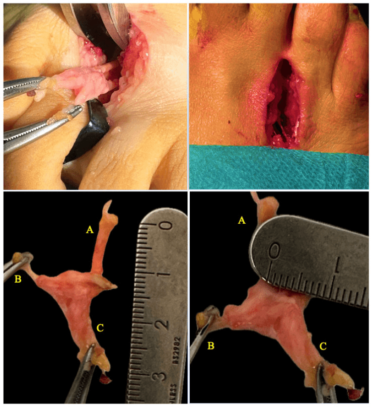 Intraoperative exposure of an interdigital neuroma through a longitudinal web-space incision, and the excised specimen measured against a ruler with its three branches labelled A, B and C