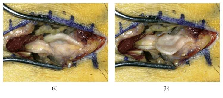 Two intraoperative photographs of an enlarged interdigital nerve exposed between retractors, from a reported case of a neuroma displaced by MTP instability