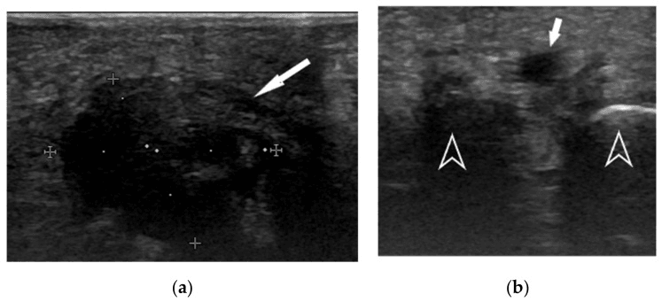 Two ultrasound panels of an interdigital lesion: a hypoechoic lesion marked by callipers and an arrow, and a smaller hypoechoic focus between two open arrowheads
