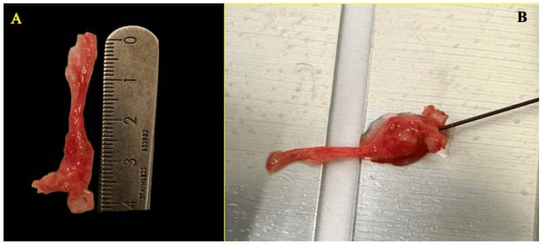 Excised Morton's neuroma measured against a ruler, then with a radiofrequency electrode applied directly to it outside the body