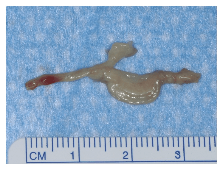 Excised interdigital nerve with a branch and an enlarged segment, beside a centimetre scale