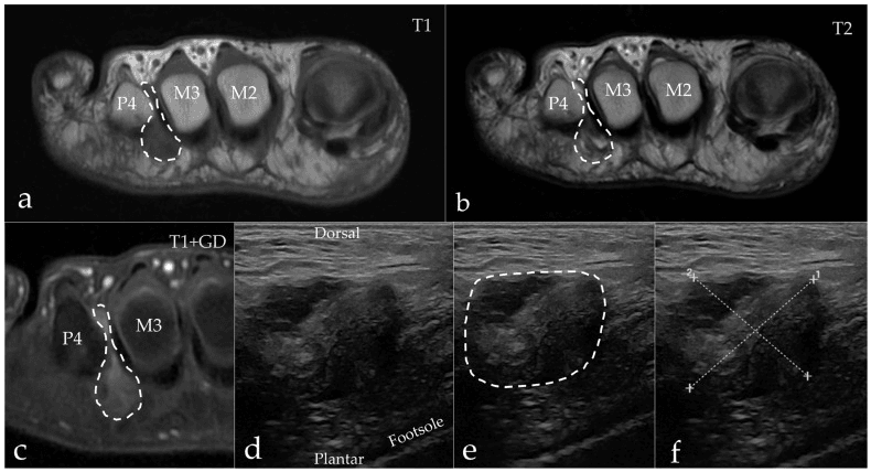 Intermetatarsal bursitis outlined on T1, T2 and gadolinium-enhanced T1 MRI, and outlined and measured on ultrasound
