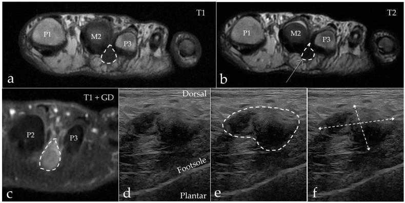Morton's neuroma outlined on T1, T2 and gadolinium-enhanced T1 MRI, and outlined and measured on ultrasound