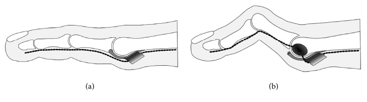 Line drawings of a lesser toe in profile comparing the course of the interdigital nerve beneath a stable toe and an unstable MTP joint