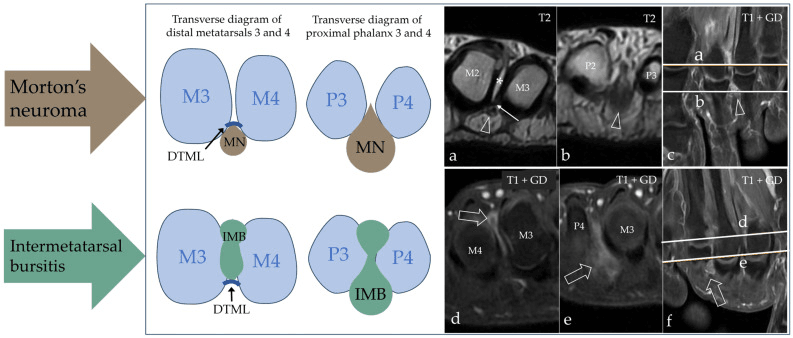Transverse diagrams and MRI comparing the position of a Morton's neuroma and intermetatarsal bursitis relative to the deep transverse metatarsal ligament