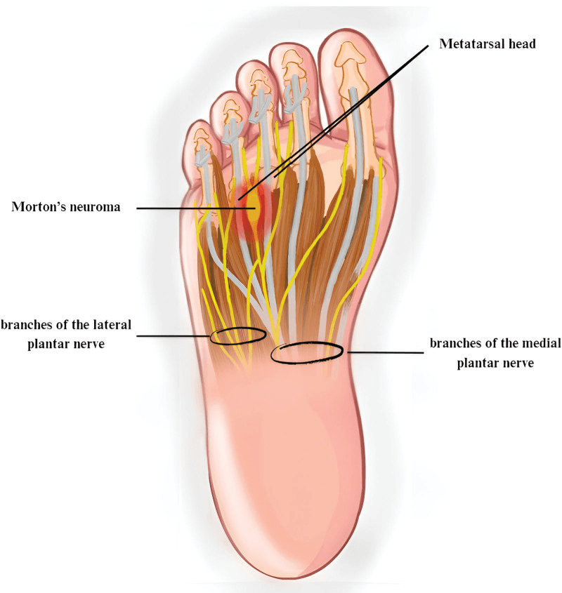 Plantar drawing of the forefoot labelling a Morton's neuroma in the third web space, a metatarsal head, and the branches of the medial and lateral plantar nerves