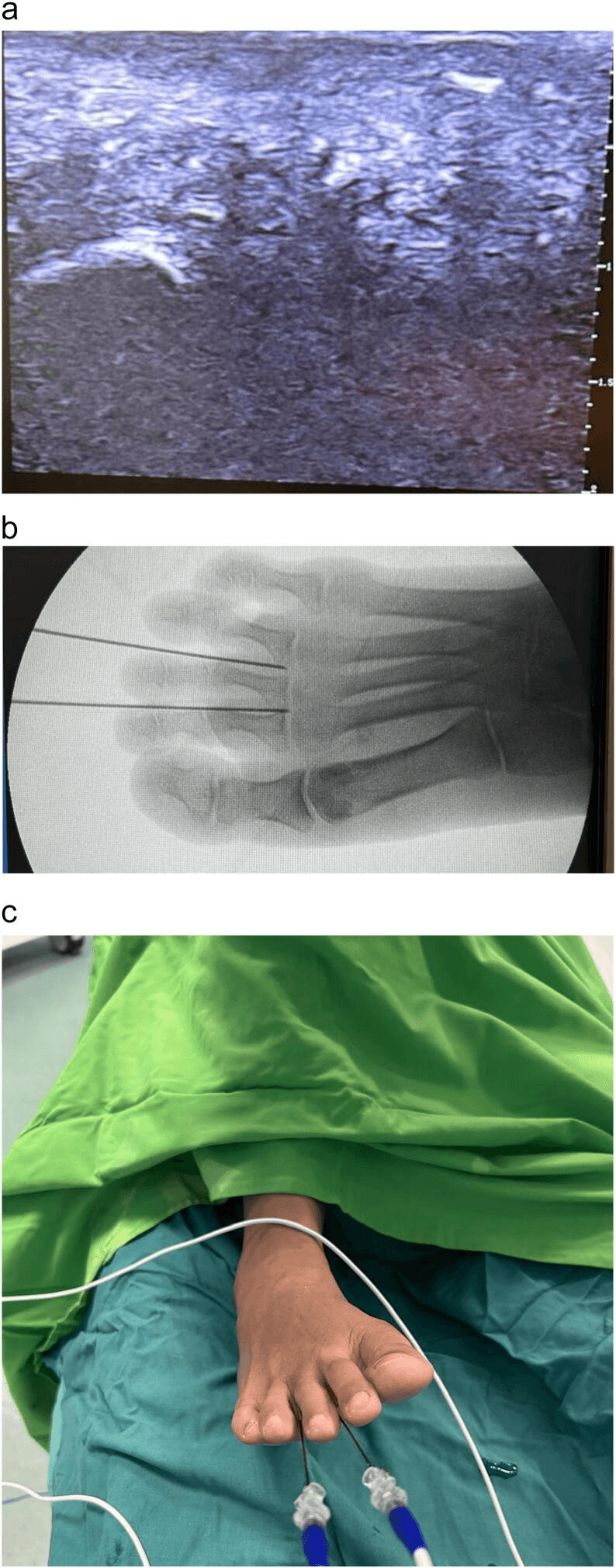 Ultrasound, fluoroscopy and clinical photograph of two pulsed radiofrequency cannulae placed in the web space of the foot