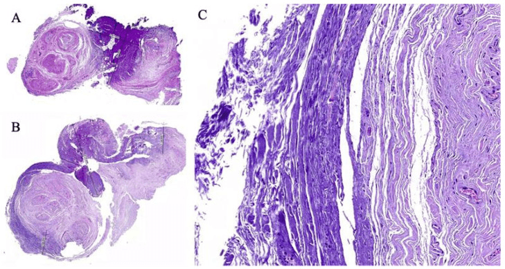 Histological sections of a Morton's neuroma after ex vivo radiofrequency application, at low and higher magnification