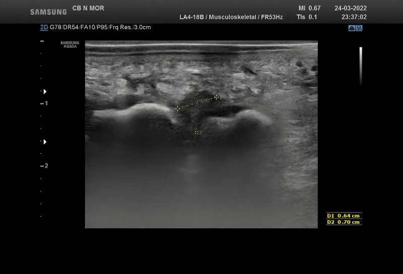 Musculoskeletal ultrasound of a hypoechoic lesion between two metatarsal heads, measured with callipers at 0.64 cm and 0.70 cm