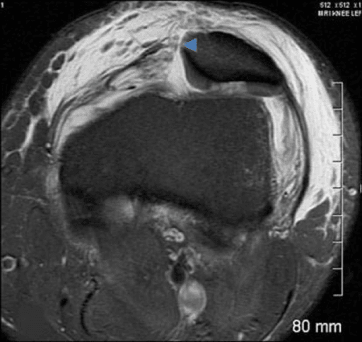 Axial T2 MRI showing a medial patellofemoral ligament tear at the patellar attachment