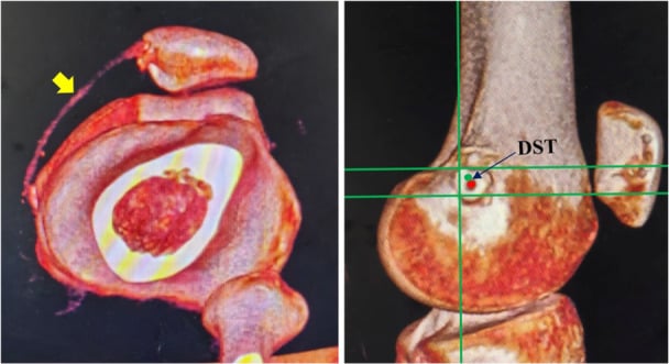 Postoperative CT reconstruction showing a reconstructed MPFL with the Schottle point marked