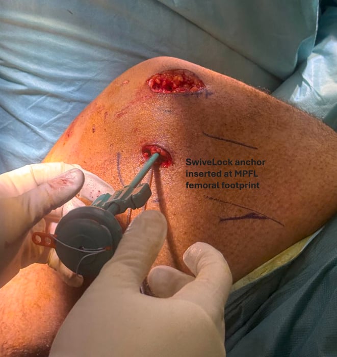 Intraoperative fixation of suture tape with a knotless anchor at the MPFL femoral footprint
