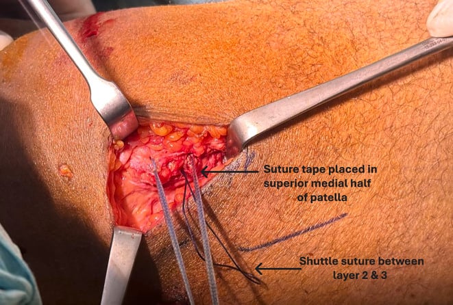 Intraoperative placement of suture tape into prepatellar soft tissue and periosteum