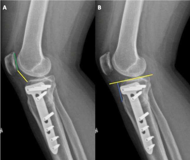 Radiographic measurement of patellar height using the Caton-Deschamps index