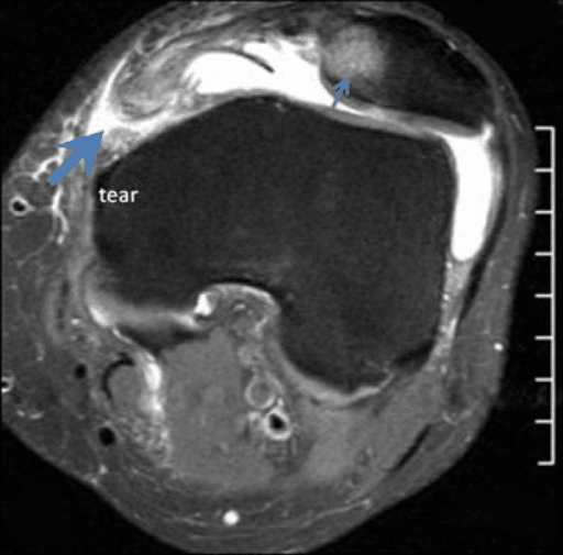 Axial T2 MRI showing a femoral-side MPFL tear with medial patellar facet bone contusion