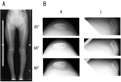 Bilateral lower limb radiographs with skyline view showing a dislocated patella