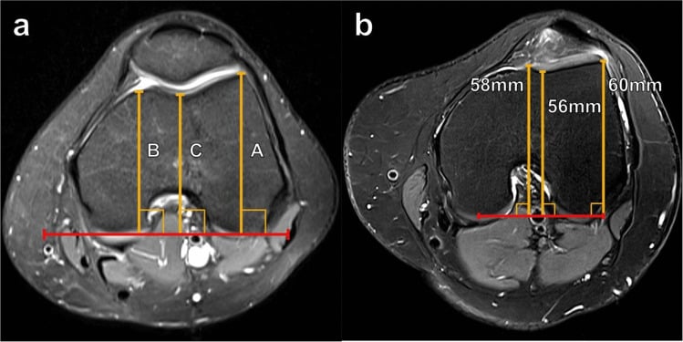 Axial fat-suppressed T2 MRI with trochlear depth measured from the posterior condylar line