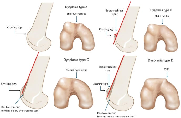 Illustration of the Dejour classification of trochlear dysplasia types A to D