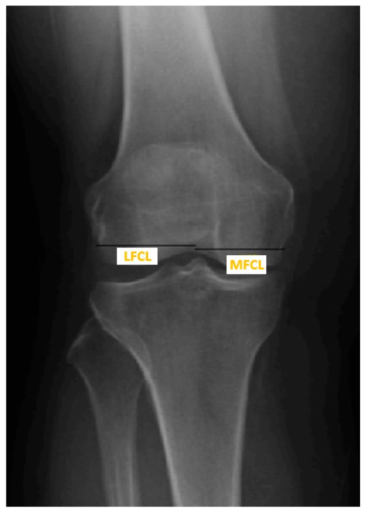 Plain radiograph with medial and lateral femoral condyle lengths measured