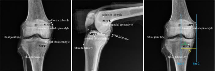 Imaging landmarks for the attachment sites of the MPFL and MPTL