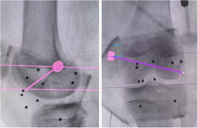 Intraoperative bone tunnel planning showing the distance between Schottle point and the medial femoral physis