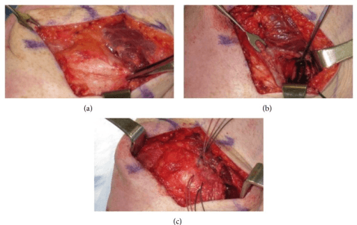 Three-panel intraoperative photos showing Allis clamp on avulsed MPFL, suture anchor placement on femur, and completed repair