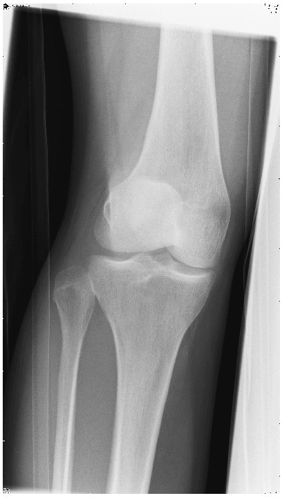 AP radiograph of the knee in a patient with patellofemoral instability