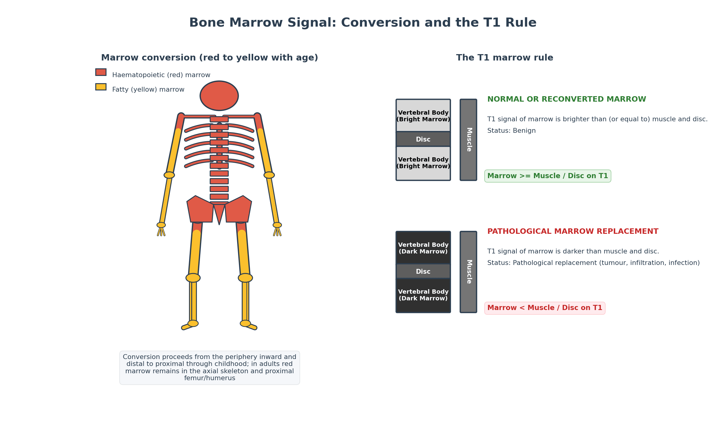 Diagram of red-to-yellow marrow conversion distribution and the T1 marrow signal rule